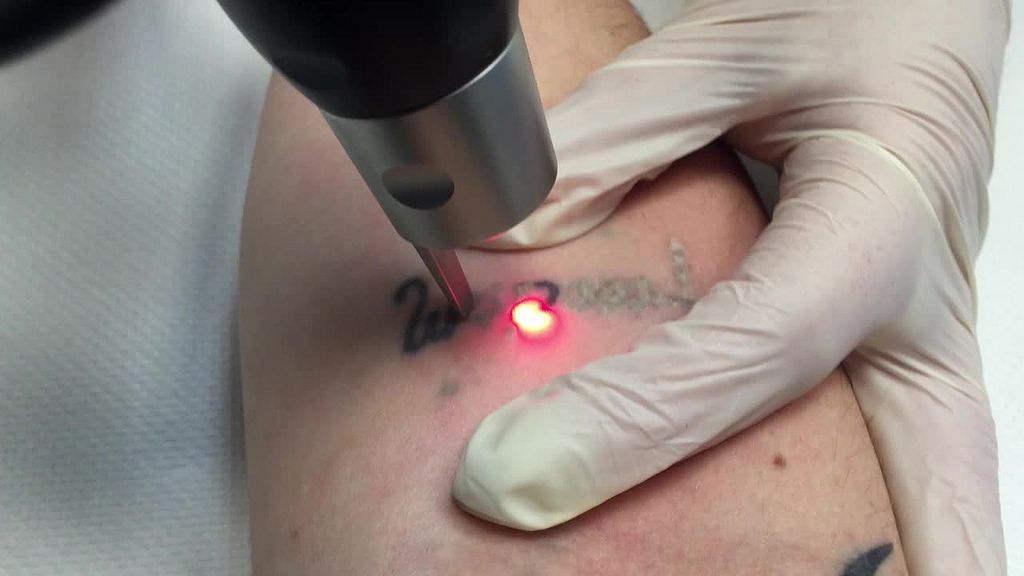 eliminación de tatuajes en Valencia