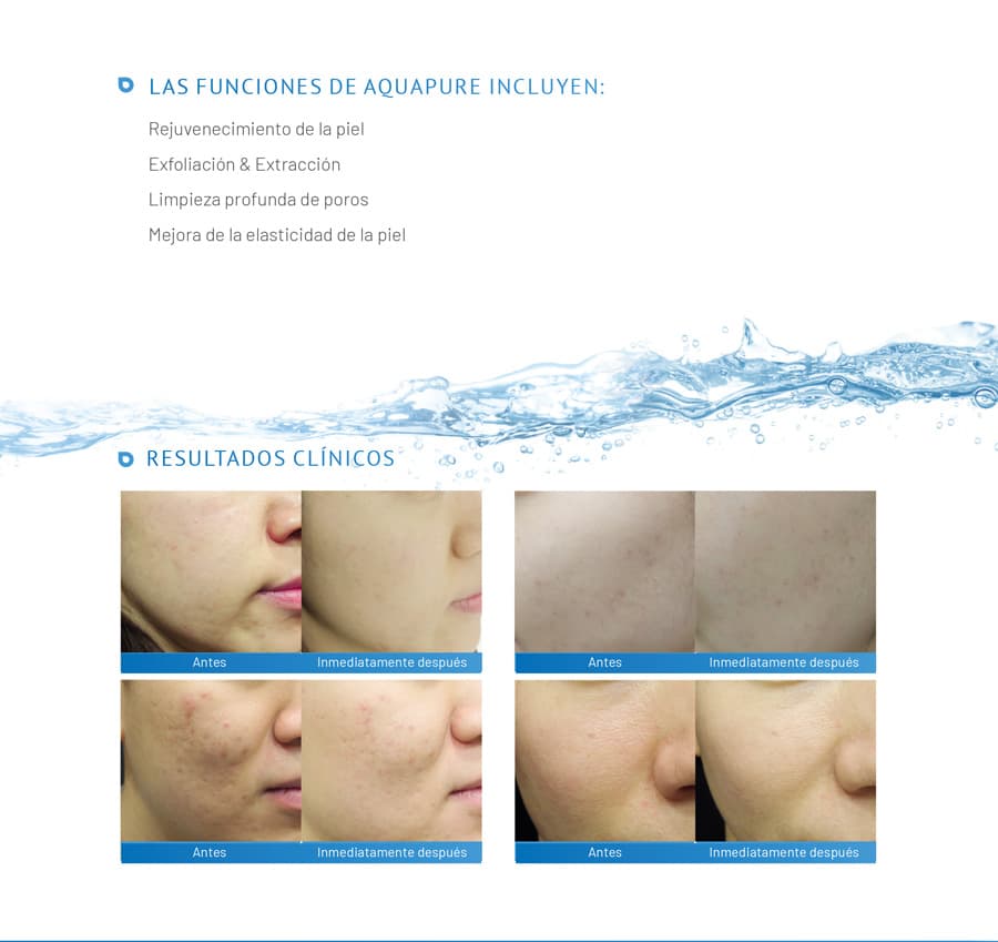 ventajas uso aquapure tratamiento acne