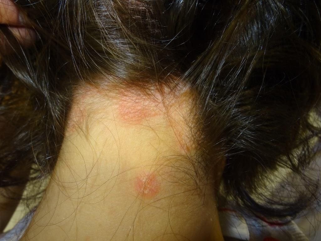 especialistas en psoriasis